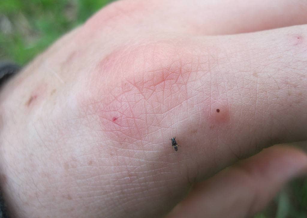 Как помочь ребенку при укусах насекомых